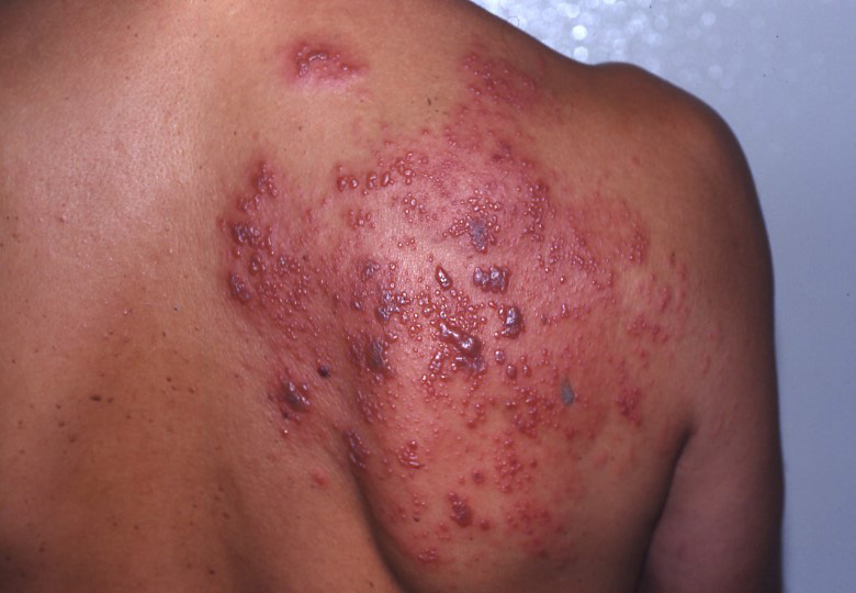 Possible herpes outbreak on shoulders and legs? | Go Ask ...