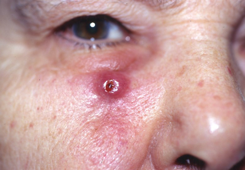 Qui est à risque de carcinome épidermoïde de la peau?