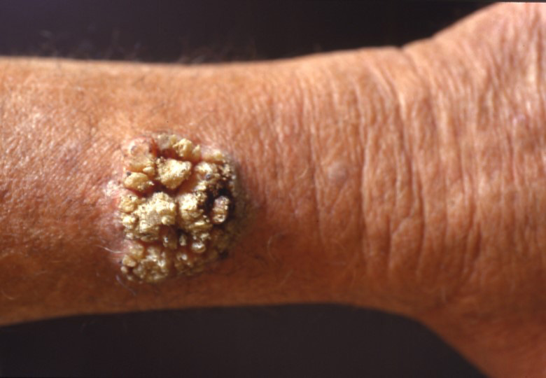 wart virus in skin